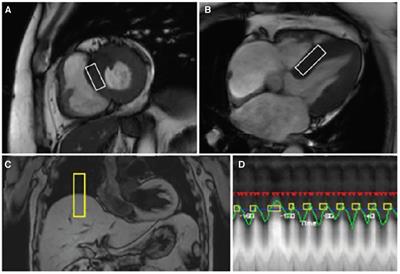 Cardiac function, myocardial fat deposition, and lipid profile in young smokers: a cross-sectional study